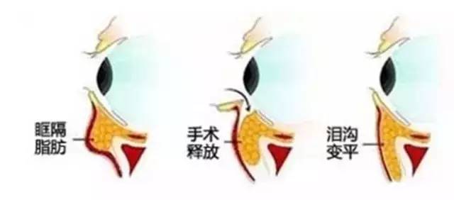 泪沟深怎么办,有了泪沟怎么补救