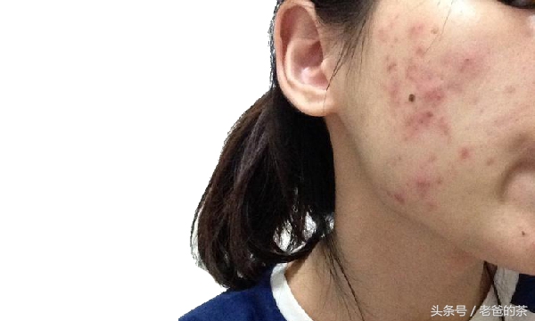 祛痘中药自制面膜,中草药面膜祛痘痘