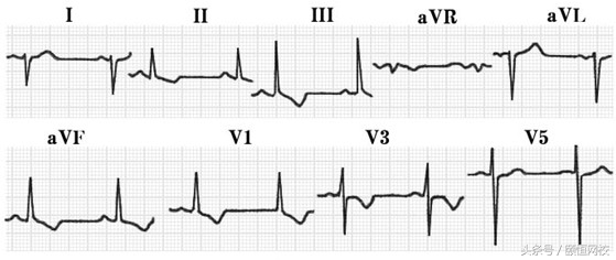 郭雅卿心电图讲解全集,郭雅卿心血管视频课