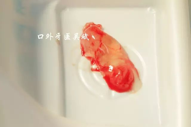 嘴里长疱疹怎么办,嘴里起脓疱怎么办