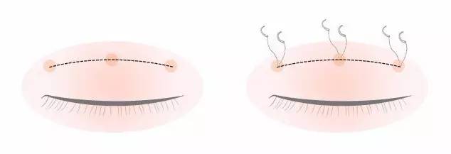 割双眼皮、垫鼻子、幽灵医生……一篇文章为你揭秘韩国整形