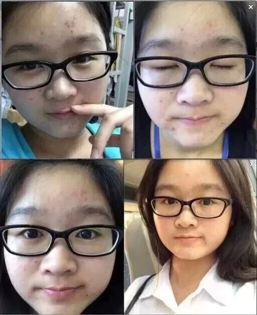 有什么方法祛痘有效最快,如何祛痘痘最有效的方法教给你