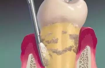 下颌阻生齿拔除技巧,下颌阻生智齿拔除会面瘫吗