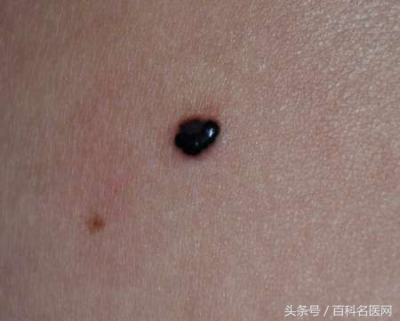 恶性肿瘤身上有很多包是咋回事,身上长个包是恶性的是什么意思