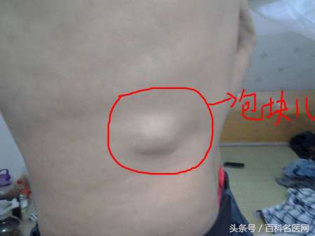 恶性肿瘤身上有很多包是咋回事,恶性肿瘤转移身上很多包块