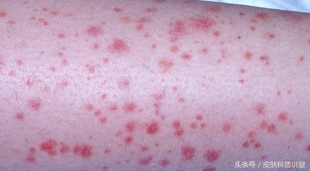 腿脚起红点是过敏性紫癜吗,小腿上出现小红点过敏性紫癜