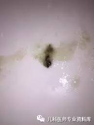 儿童黄鼻涕粘稠,儿童鼻炎鼻涕多