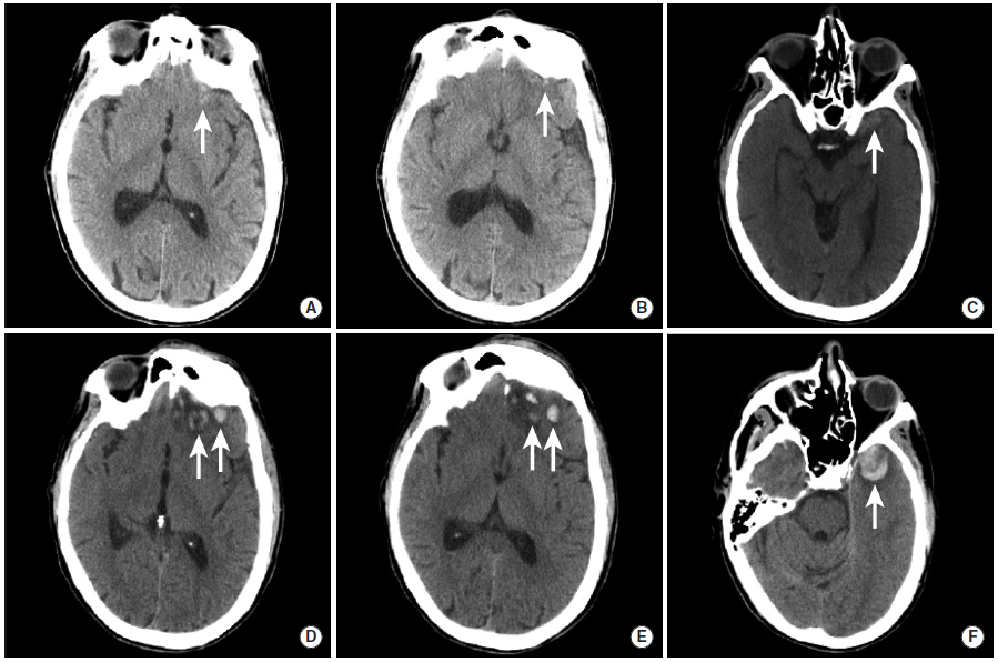 多图颅内出血影像学表现大全,头被撞后颅内出血有什么表现