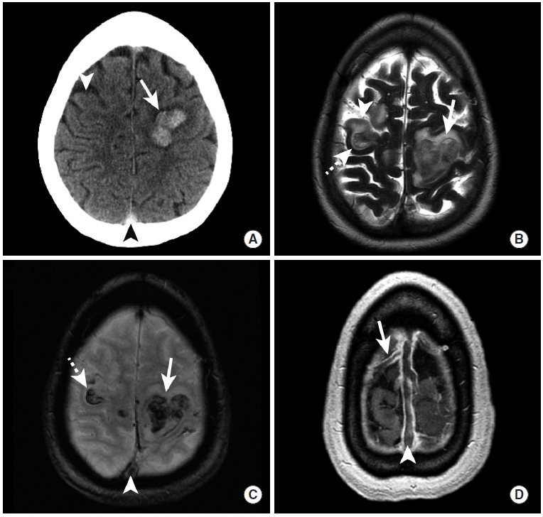 多图颅内出血影像学表现大全,头被撞后颅内出血有什么表现