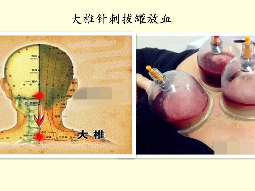 风寒感冒针刺放血注意事项,通过放血治疗疾病方法可取吗