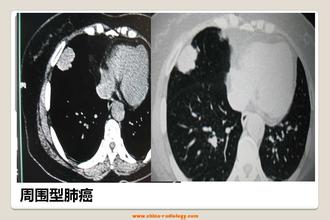 高考体检肺部有阴影能通过吗,体检肺部有阴影是怎么回事