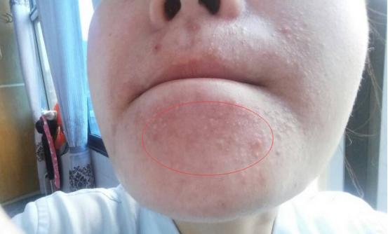 下巴长小丘疹连成片发红结痂,下巴长了密密麻麻的小丘疹怎么办