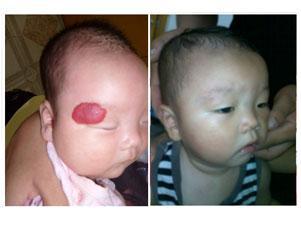 宝宝血管瘤好治吗？能治好吗？把握四点不在担心