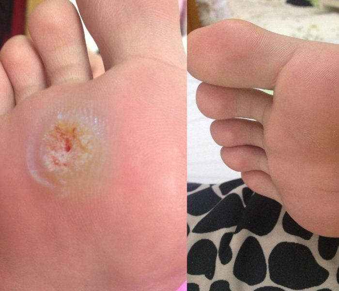 长鸡眼有什么好的土方法,为什么长鸡眼简单一招搞定