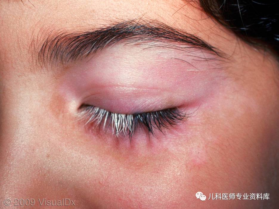 湿疹后有白斑是怎么回事,湿疹后白斑是白癜风