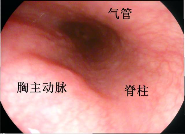 当EUS遇到“假瘤子”(二)——都是“隔壁老王”惹的祸(毗邻外压)