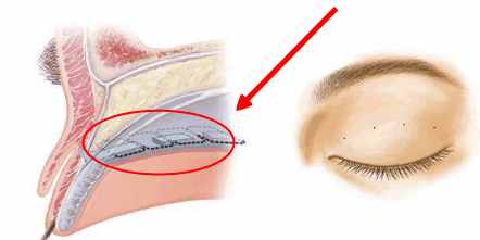 埋线双眼皮的正确操作手法,埋线双眼皮很浅