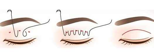 埋线双眼皮的正确操作手法,埋线双眼皮很浅