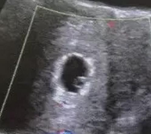 胎停的判断标准,b超怎么判断胎停