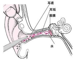 鼓膜穿刺术有后遗症吗,鼓膜穿刺术多少钱