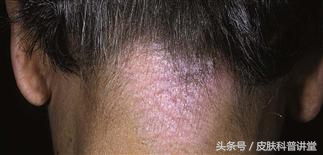 反复神经性皮炎是缺什么,神经性皮炎反反复复如何根除