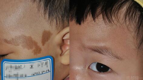 孩子有胎记如何避免孩子自卑,宝宝长胎记怎样避免心理健康