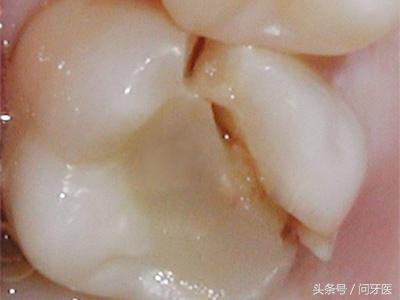 牙齿上有裂纹怎么办,牙齿上有裂纹怎么治