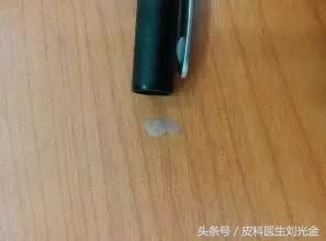 头皮屑多是不是缺少维生素b2,头皮屑多是不是皮肤病