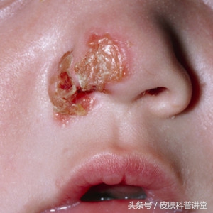 一张图教你辨别脓疱疮,皮肤科普直播