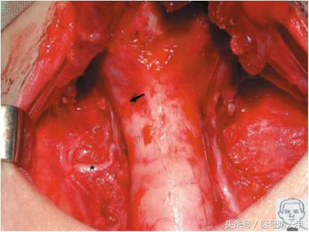 喉返神经的解剖视频,损伤喉上神经和喉返神经的区别