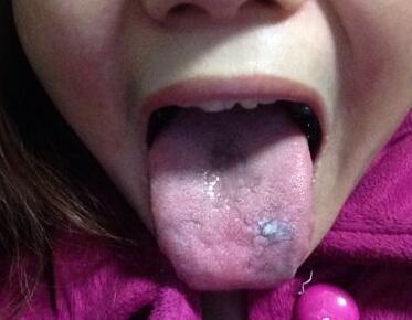 舌头反映心脏健康，淤斑、发红说明心脏有疾病了！