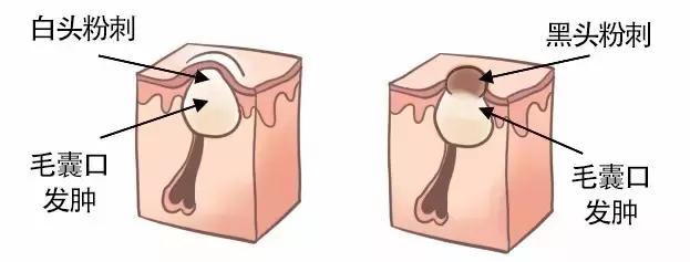 angelababy痘痘,angelababy额头冒巨痘