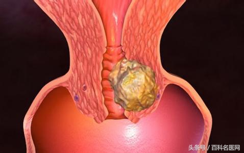 宫颈炎没有治疗会转变成hpv吗,宫颈炎会发展成为宫颈癌吗