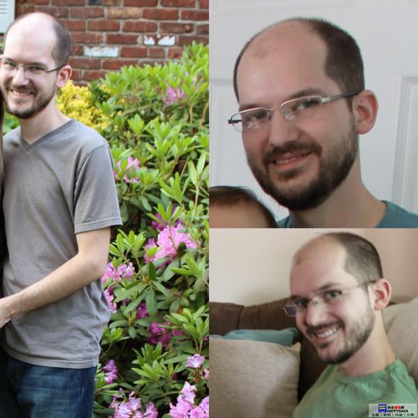 雌激素治脱发,雄性激素脱发补充雌性激素有用吗