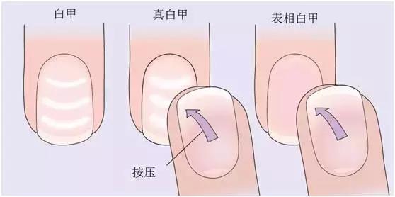 指甲变色变厚怎么处理,指甲变色了怎么办