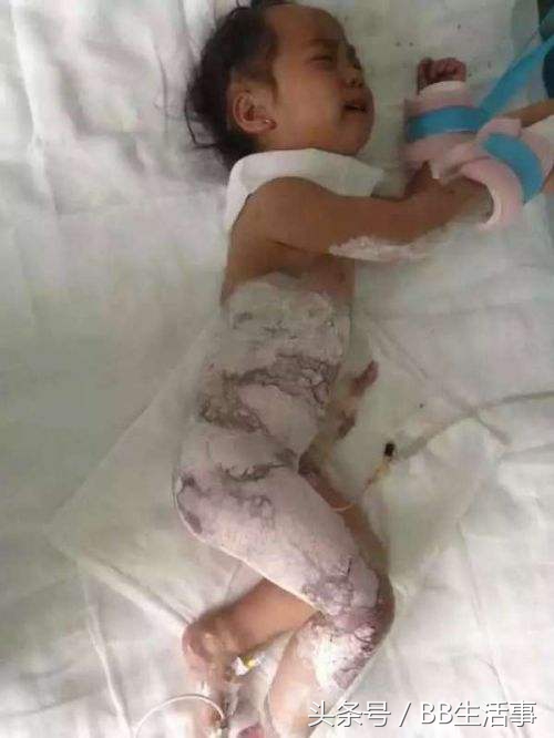 皮肤烫伤怎么办5步教你如何急救,宝宝烫伤后正确的急救措施