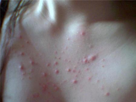 如何消除小肚子湿气,小肚子大湿气重效果最好的办法