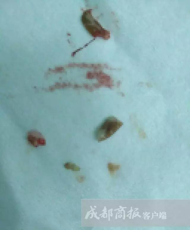 男孩咳嗽一星期被发现白肺,8个月男童反复咳嗽