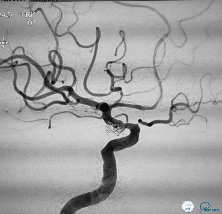 支架辅助弹簧圈栓塞治疗狭窄伴复杂动脉瘤