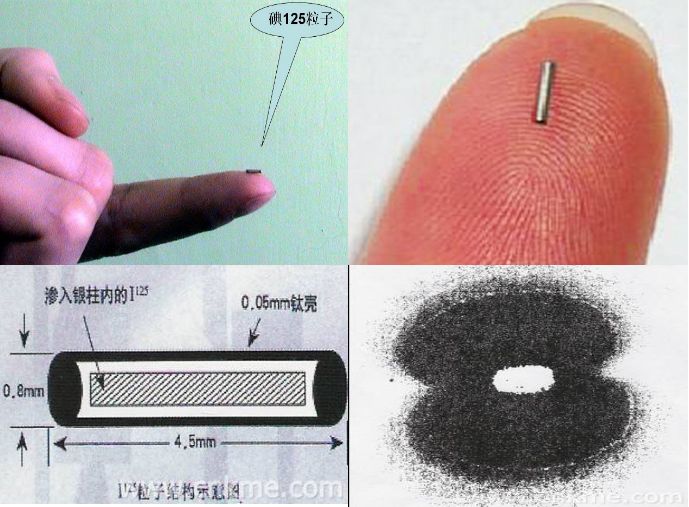 治疗肺癌的“核”*器武**——肺癌放射性粒子植入手术