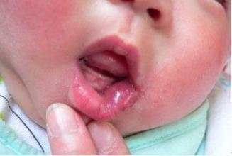 血管瘤破裂了会怎么样啊,血管瘤怎么会破裂