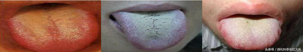 反流食管炎加萎缩性胃炎中医治疗,反流性食管炎中医把脉能看出来吗