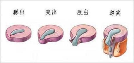 20岁腰椎间盘突出可以完全康复吗,关于腰椎间盘突出你需要知道的