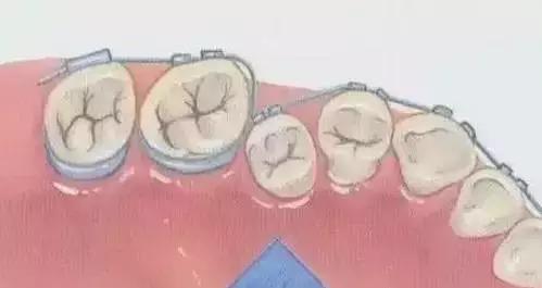 矫正钢丝末端扎嘴怎么解决,矫正钢丝末端扎嘴在家怎么办