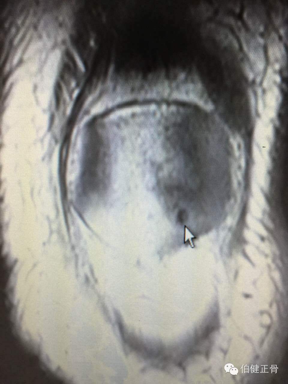 髌骨软化症怎么治疗效果好,髌骨软化症膝盖疼怎么治疗