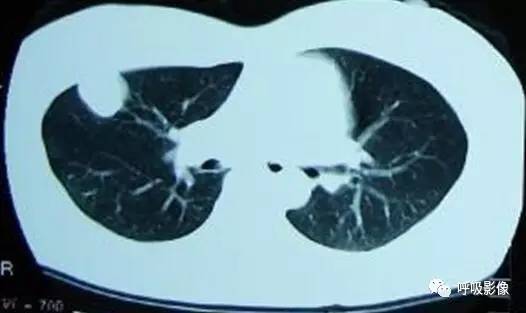 绒毛膜癌转移到脑,绒毛膜癌肺转移