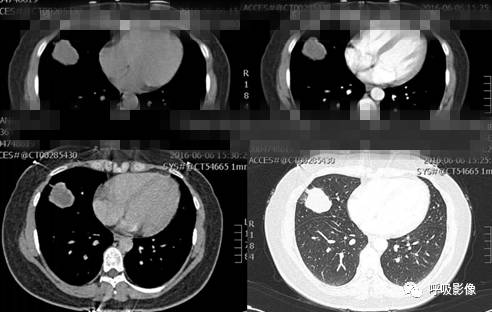 绒毛膜癌转移到脑,绒毛膜癌肺转移