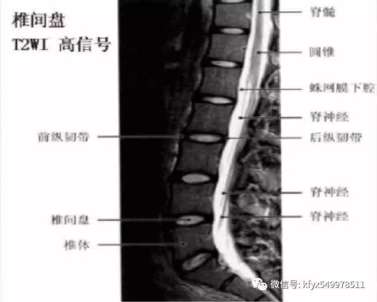 教你如何看腰椎磁共振