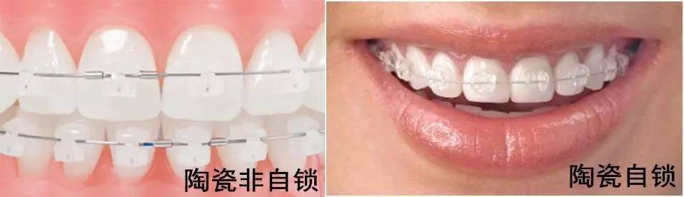 隐形牙套整牙全过程介绍,拔掉四颗牙隐形牙套矫正的全过程