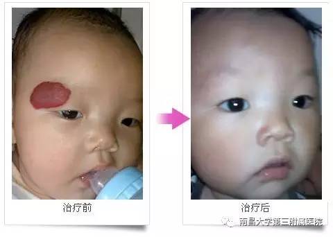 哪些胎记有危险,宝宝胎记是什么原因造成的